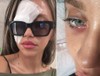 Zeynep Alkan gözünden ameliyat oldu