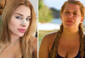 Survivor Almeda Baylan estetik yaptırdı