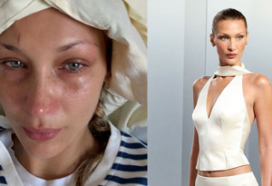 Bella Hadid, Lyme hastalığıyla mücadelesini anlattı