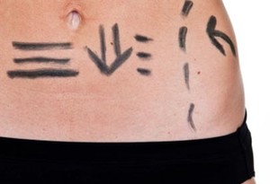 "Güldüren liposuction" ile yağlara veda