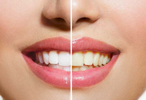 Diş Beyazlatma Yöntemleri