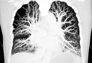 Pulmonar emboliyi önemseyin!