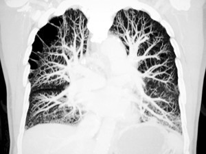 Pulmonar emboliyi önemseyin!