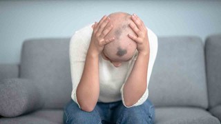Saçkıran (Alopesi areata) nedir? Saçkıran belirtileri neler? 8 soruda Saçkıran (Alopesi areata)