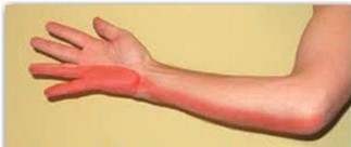 El uyuşması neden olur? El uyuşması nasıl geçer? 7 soruda el uyuşması - Resim : 3
