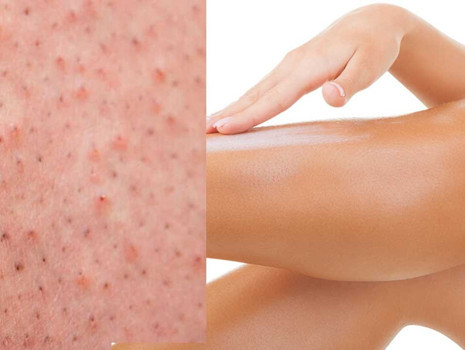 Çilek bacak görünümü nasıl geçer? 7 önerimiz var