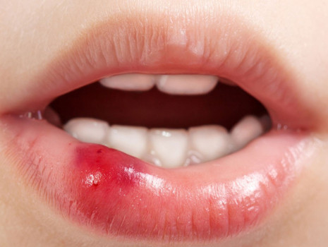 Dudak yarasına ne iyi gelir?