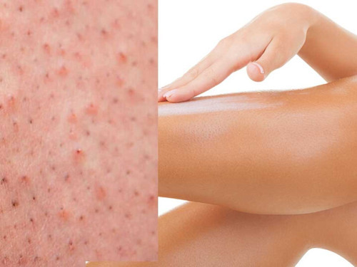 Çilek bacak görünümü nasıl geçer? 7 önerimiz var