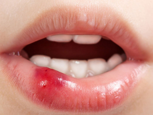 Dudak yarasına ne iyi gelir?