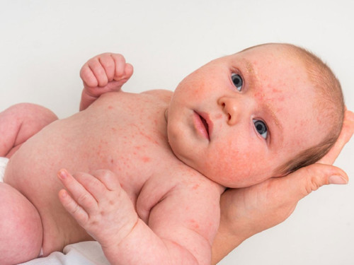 Altıncı hastalık nedir, belirtileri neler? Nasıl tedavi edilir?