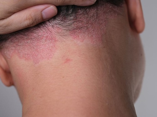 Seboreik dermatit nedir, belirtileri neler?