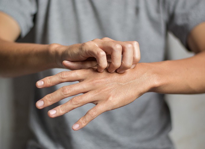 Uyuz belirtileri neler? Neden olur? Uyuz hastalığı nasıl bulaşır? 8 soruda uyuz hastalığı - Resim : 2