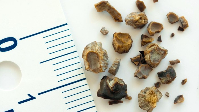 Aşırı terleme sebebiyle idrara çıkamama, böbrek taşı yapıyor - Resim : 2