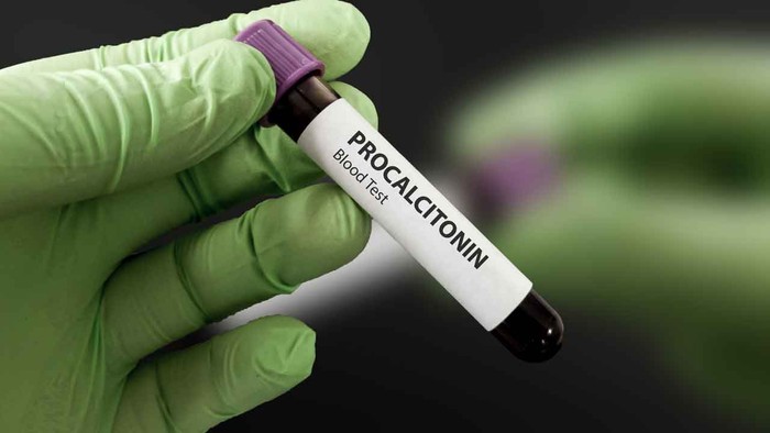 Prokalsitonin (PCT) nedir? Prokalsitonin neden bakılır? Prokalsitonin değeri kaç olmalı? - Resim : 1