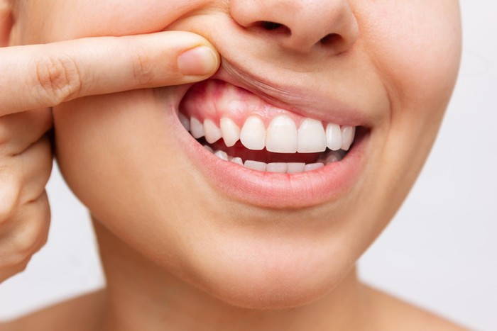 Diş eti büyümesi neden olur? Nasıl tedavi edilir? Diş eti büyümesi hakkında 6 soru cevap - Resim : 1