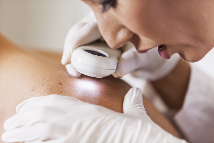 Euromelanoma ile ücretsiz ben muayenesi ve cilt kanserine erken teşhis! - Resim : 2