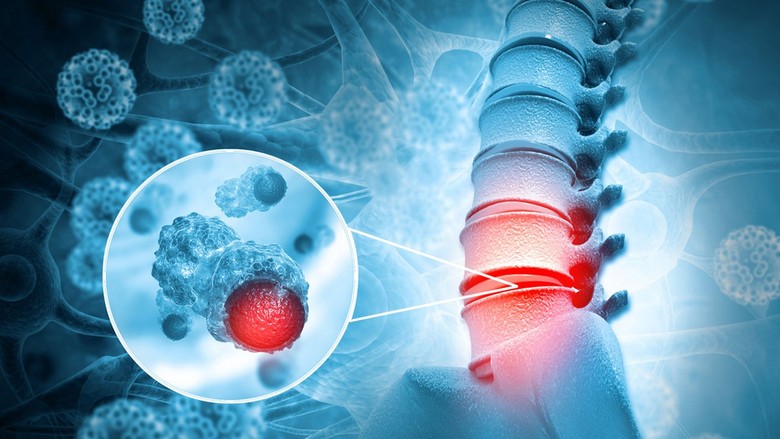 Kemik metastazı nedir, belirtileri neler? 7 soruda kemik metastazlarına dair bilinmesi gerekenler