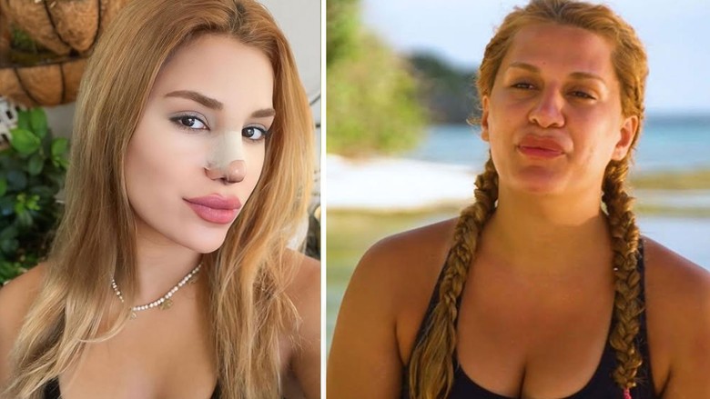 Survivor Almeda Baylan estetik yaptırdı