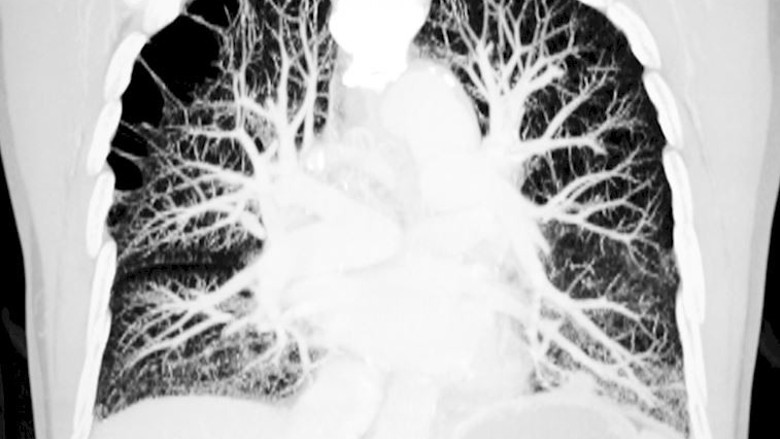 Pulmonar emboliyi önemseyin!
